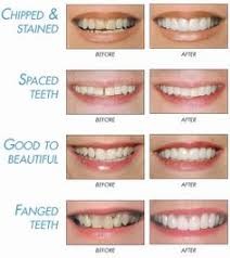 Achieve a dazzling smile with Lumineers