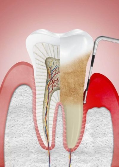 La periodontitis multiplica por 9 la mortalidad por COVID-19