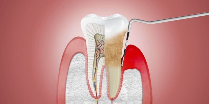 Periodontitis multiplies covid-19 mortality by 9